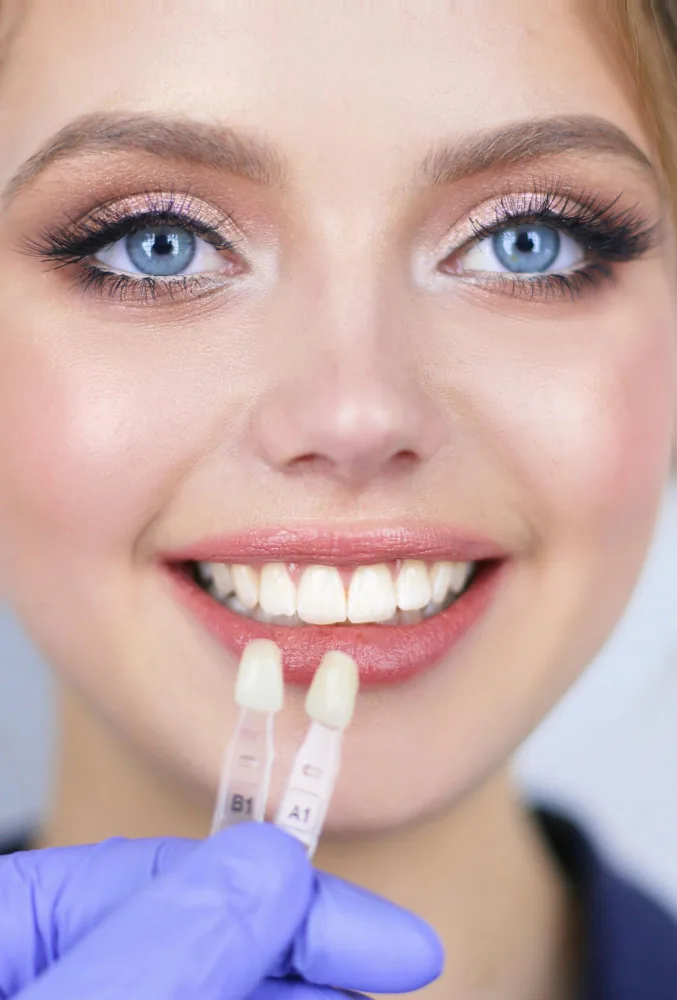 Porcelain Veneers in Kochi — Smiline Dental Clinic